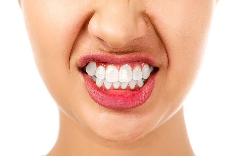 woman with bruxism grinding her teeth
